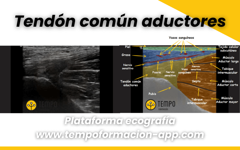 Anatomía Y Ecografía Cadera Tempo Formación 6252